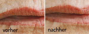 Lippenfältchen reduzieren