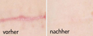 Narbenbildung