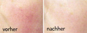 Flächige Couperose bzw. Pigmentflecken